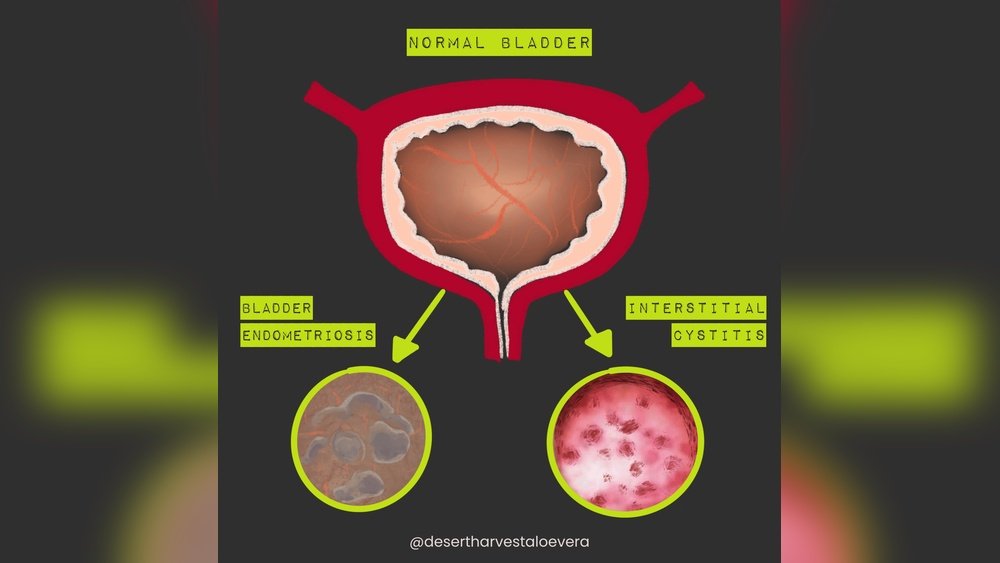 Medicinal Mushrooms for Interstitial Cystitis: Bladder Support Options