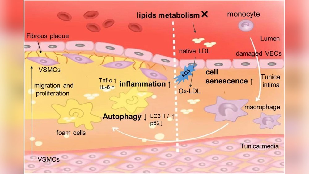 Shiitake for Atherosclerosis: Preventing Plaque Buildup Naturally